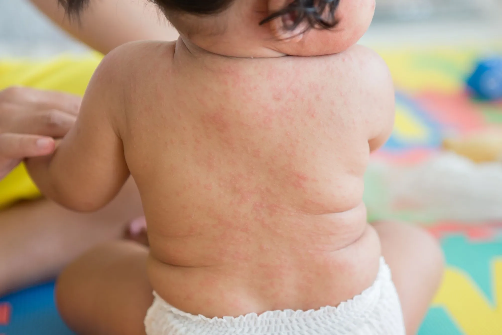 玫瑰疹常見於6個月或以下嬰幼兒