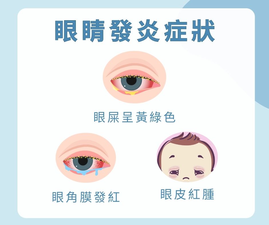 眼睛發炎的症狀包括眼角膜發紅、眼皮紅腫及眼屎呈黃綠色