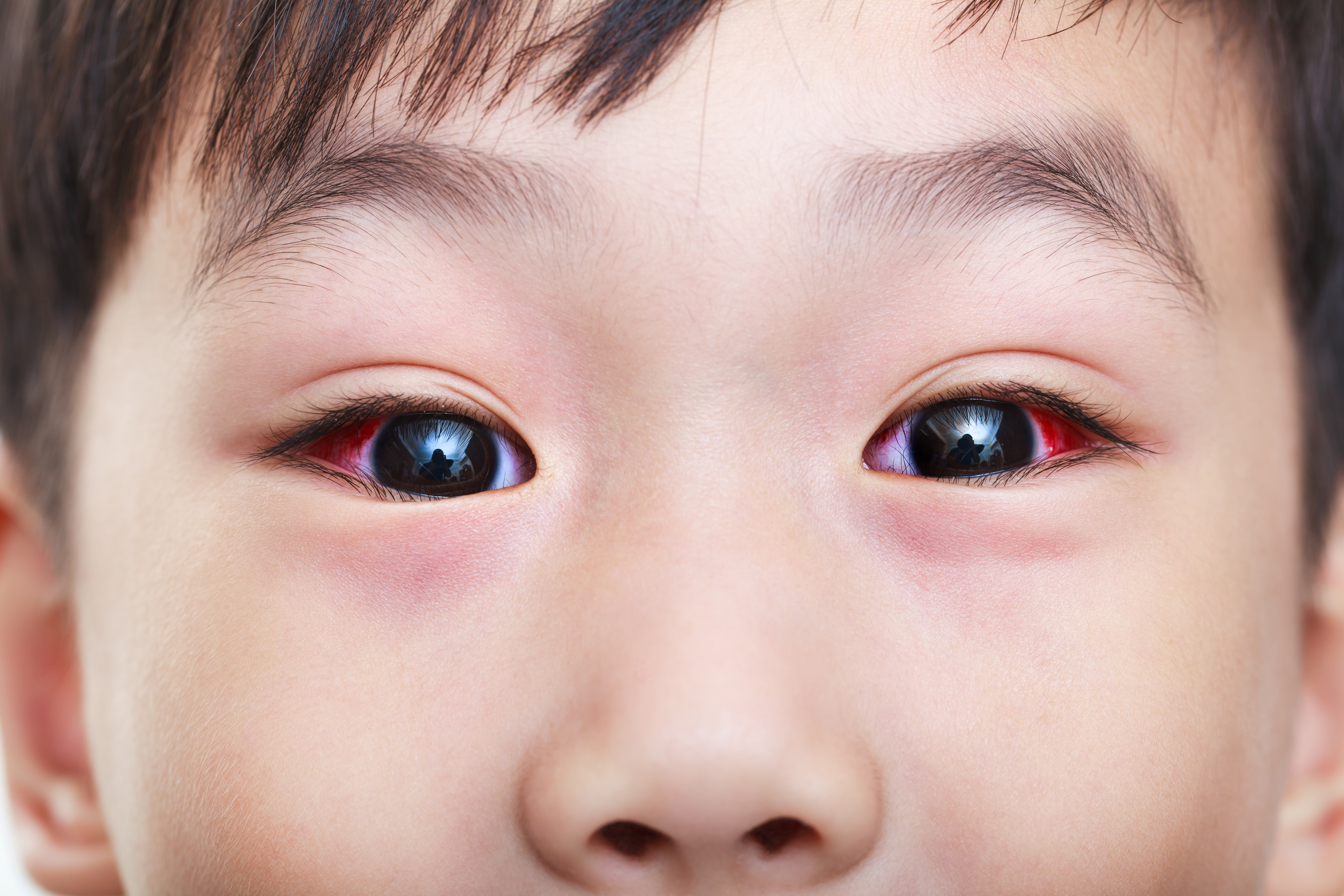 紅眼症是嬰幼兒常見眼疾