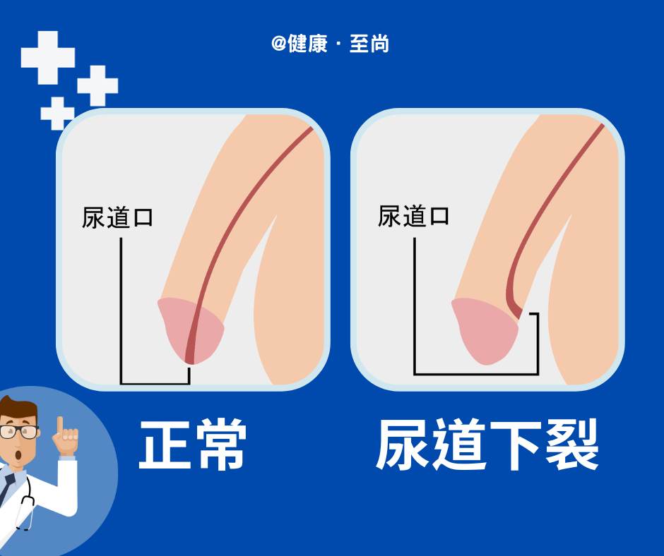 正常尿道 vs 尿道下裂