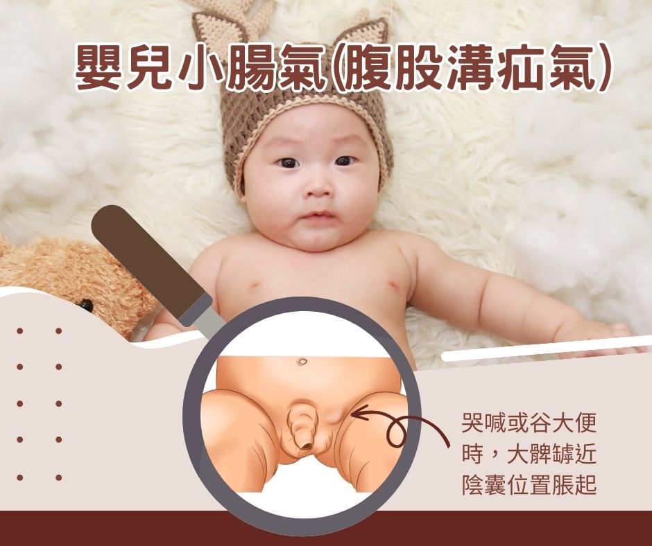 嬰兒小腸氣/腹股溝疝氣